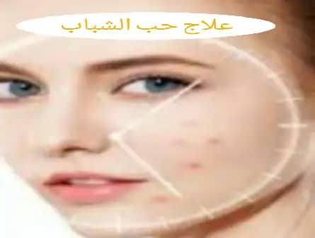 طرق علاج حب الشباب نهائياً